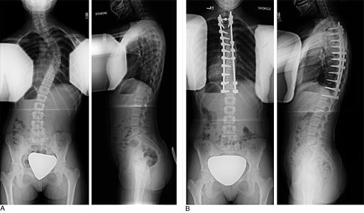 Adolescent idiopathic scoliosis