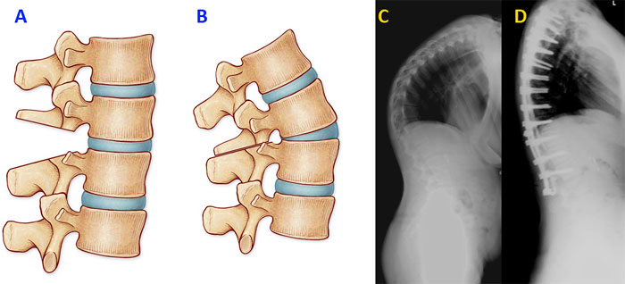 Surgery  Scoliosis Research Society