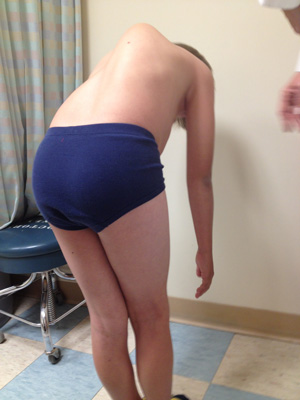 Image of Scoliosis
