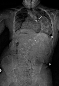 Xray of Scoliosis