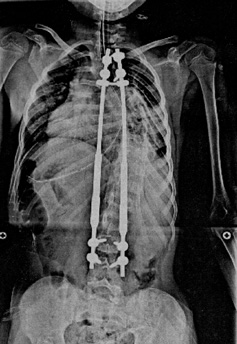 X-Ray of corrected Scoliosis