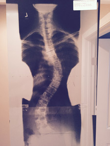 X-ray image of a spine with Scoliosis