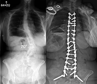 Side by Side X-Ray images of a spine- left pre-op - right post-op